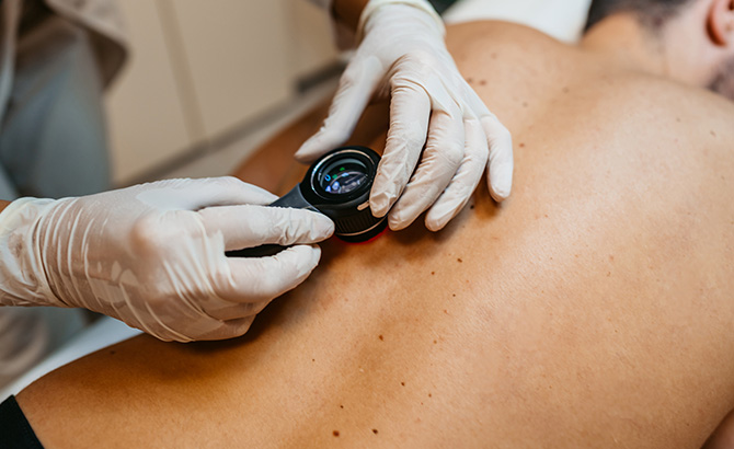 Dépistage d'un cancer de la peau